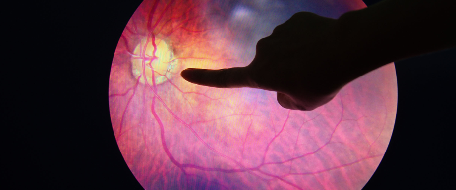 Diabetes and Eyes – Diabetic Retinopathy